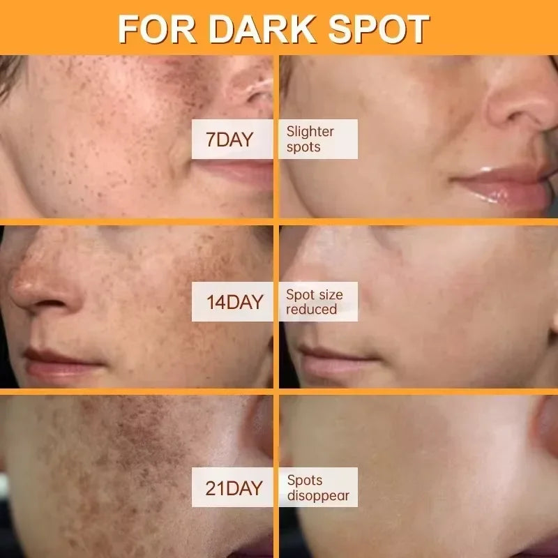 Whitening Freckles Face Cream Removal Melasma Dark Spots Corrector Lighten Melanin Pigmentation Brighten Anti-Aging Beauty Ca