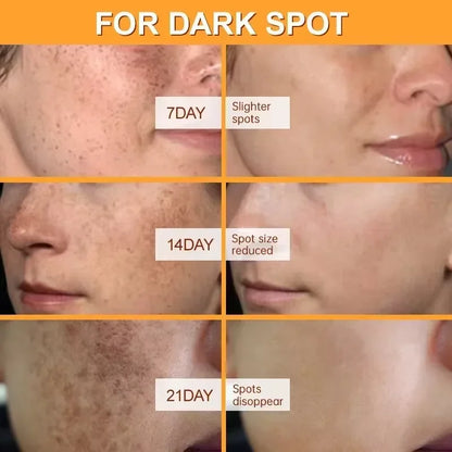 Whitening Freckles Face Cream Removal Melasma Dark Spots Corrector Lighten Melanin Pigmentation Brighten Anti-Aging Beauty Ca