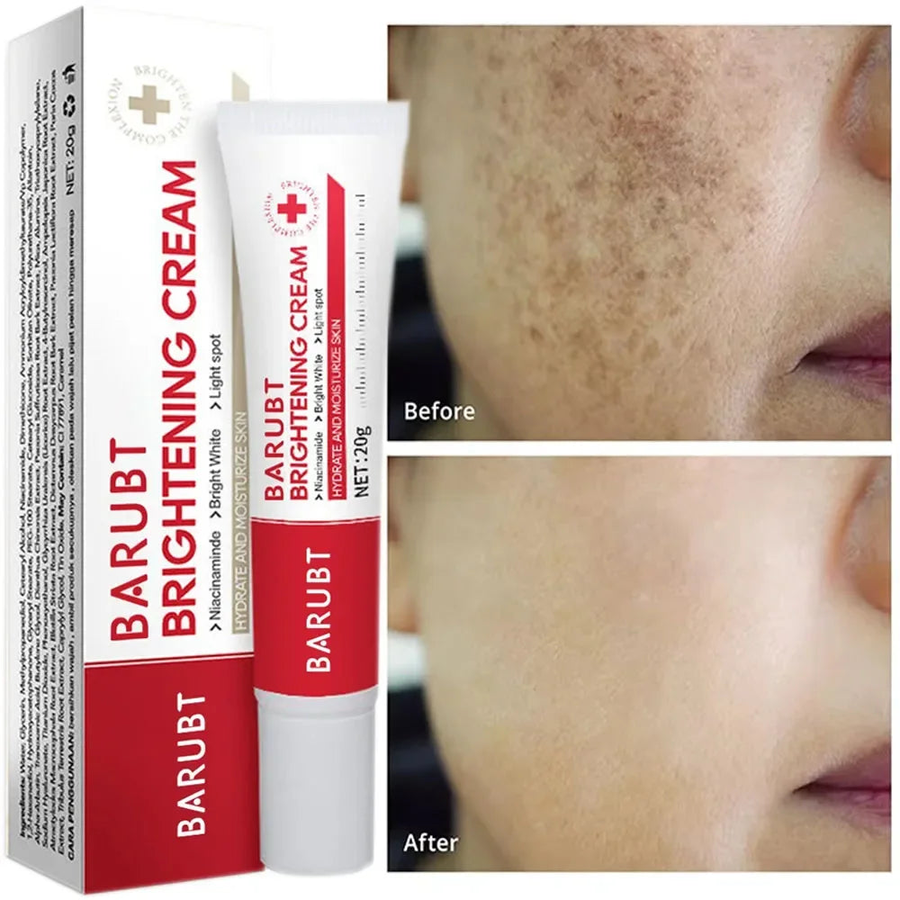 Whitening Freckles Face Cream Removal Melasma Dark Spots Corrector Lighten Melanin Pigmentation Brighten Anti-Aging Beauty Ca