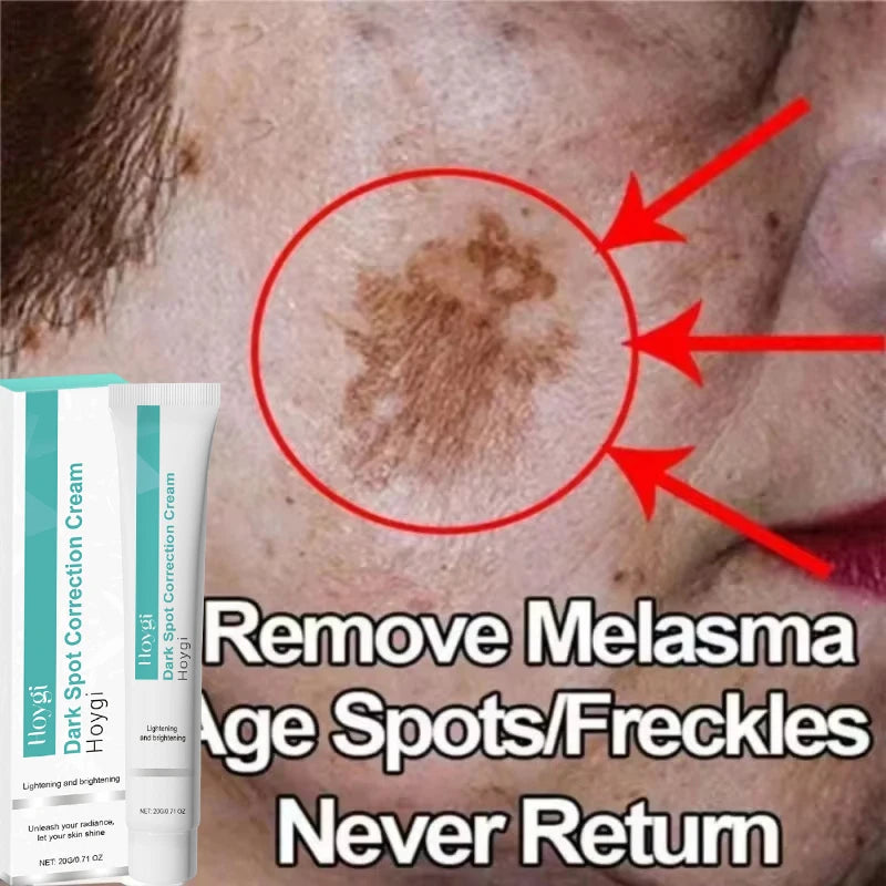Powerful Spot-removing Whiten Cream Brighten Skin Fast Eliminates Melanin Pigmentation Melasma Dark Spots Moisturize Beauty G