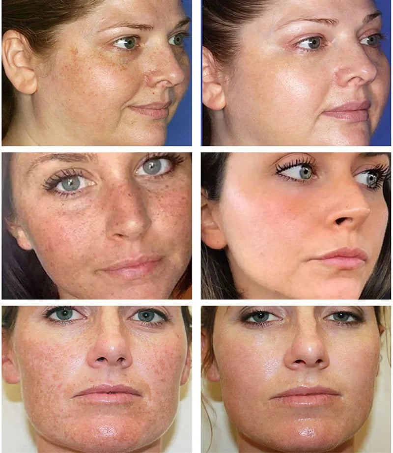 Powerful Spot-removing Whiten Cream Brighten Skin Fast Eliminates Melanin Pigmentation Melasma Dark Spots Moisturize Beauty G