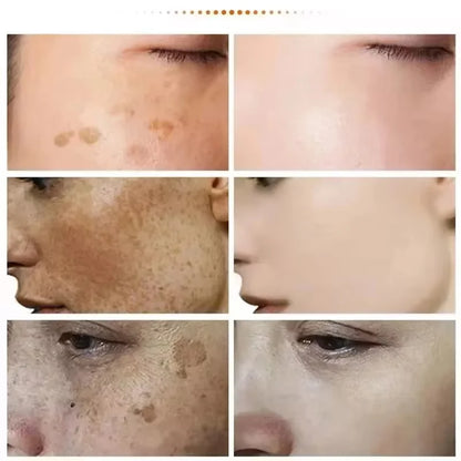 Powerful Spot-removing Whiten Cream Brighten Skin Fast Eliminates Melanin Pigmentation Melasma Dark Spots Moisturize Beauty G