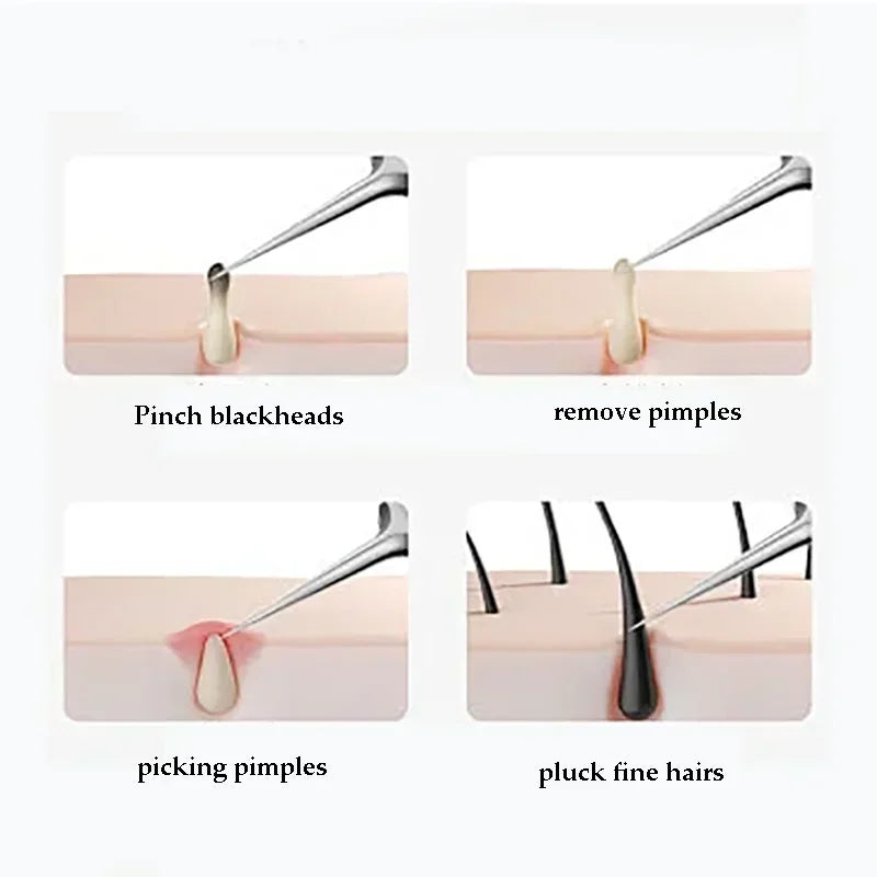 4-11Pcs Ingrown Hair Tweezers Acne Blackhead Removal Needles Black Dots Cleaner Deep Cleansing Pore Cleaner Face Skin Care To